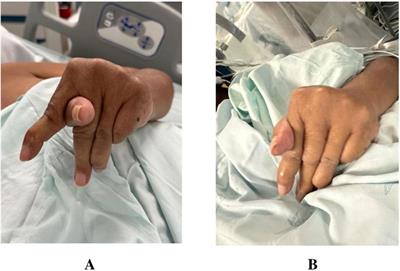 Case report: Effective globus pallidus internus deep brain stimulation for patient with stiff-person syndrome